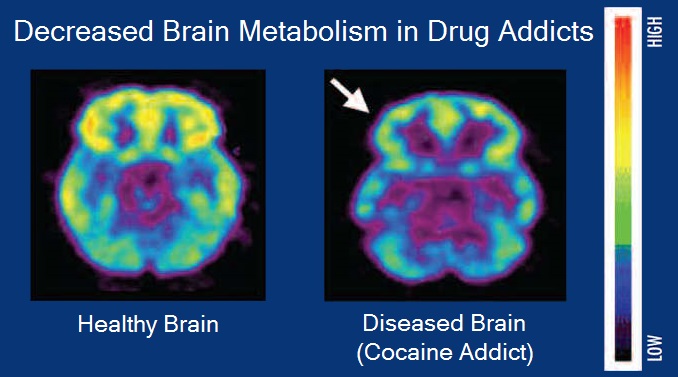 Vpliv zlorabe drog na delovanje možganov