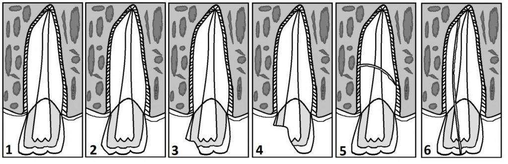 Poškodbe trdih zobnih tkiv