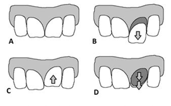 Poškodbe parodontalnega tkiva